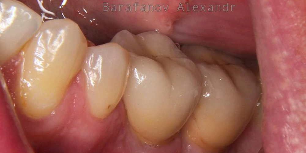  Имплантация 2 имплантатов и протезирование зубов под ключ