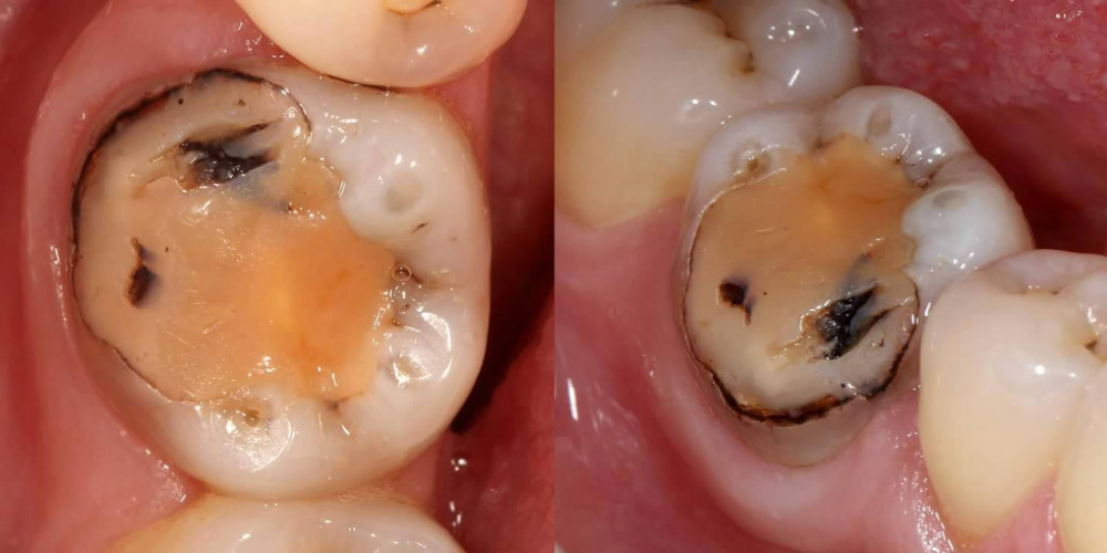 Исходная ситуация. Зуб 46, жалобы на эстетику. Эндодонтическое лечение и реставрация зуба
