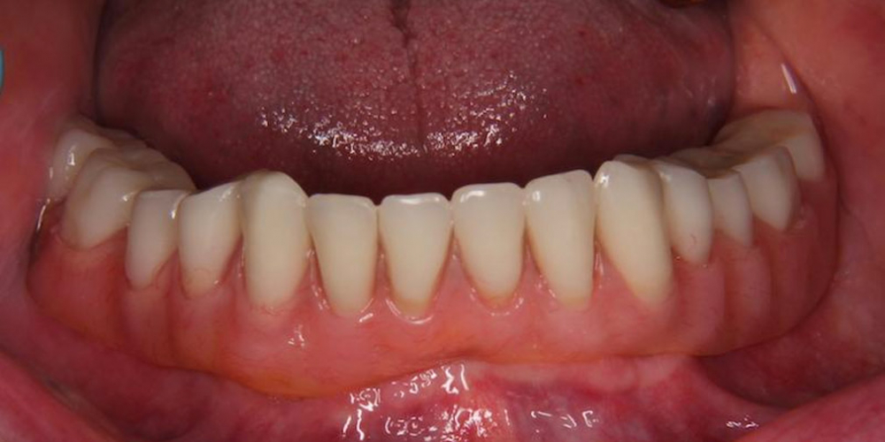 7. Фиксация Протеза в полости рта. Одномоментная постановка 4 имплантатов, протезирование нижней челюсти