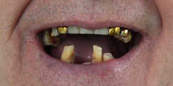 Одномоментная постановка 4 имплантатов, протезирование нижней челюсти фото до лечения