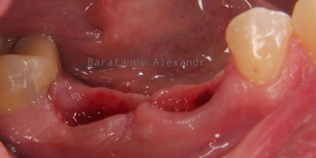 Имплантация 2 имплантатов и протезирование зубов под ключ фото до лечения