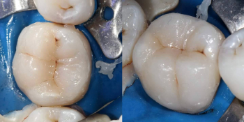 Эндодонтическое лечение и реставрация зуба фото после лечения