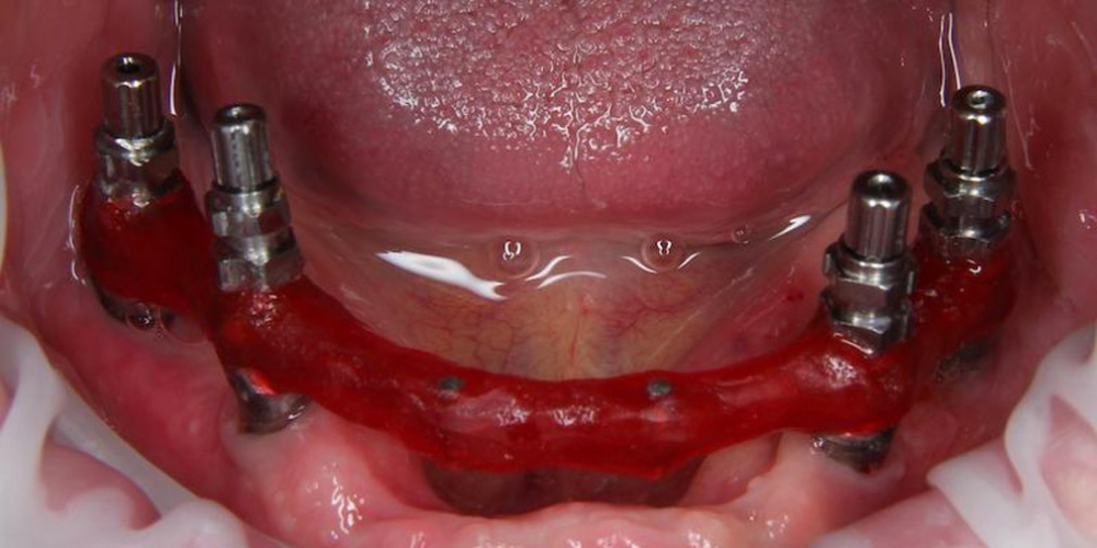 3. Изготовление зубным техником Индивидуальной ложки и ТрансферЧека на 4 имплантата. Одномоментная постановка 4 имплантатов, протезирование нижней челюсти